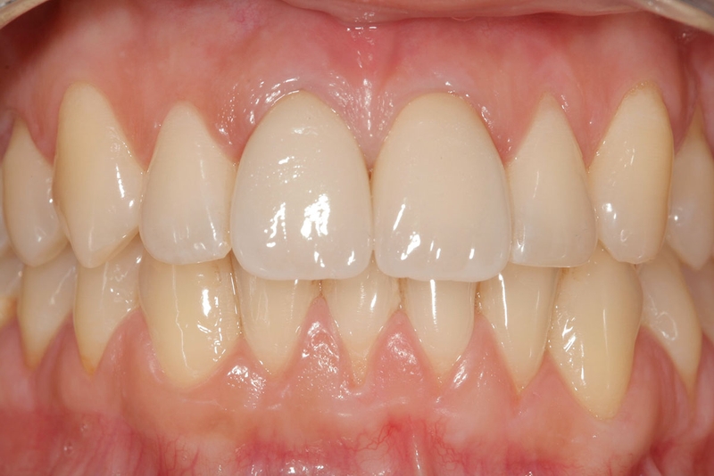 Восстановление зубного ряда, лечение бруксизма