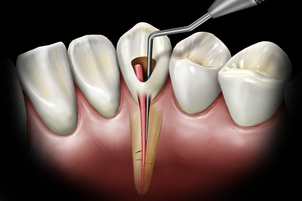 Лечение хронического периодонтита бокового зуба